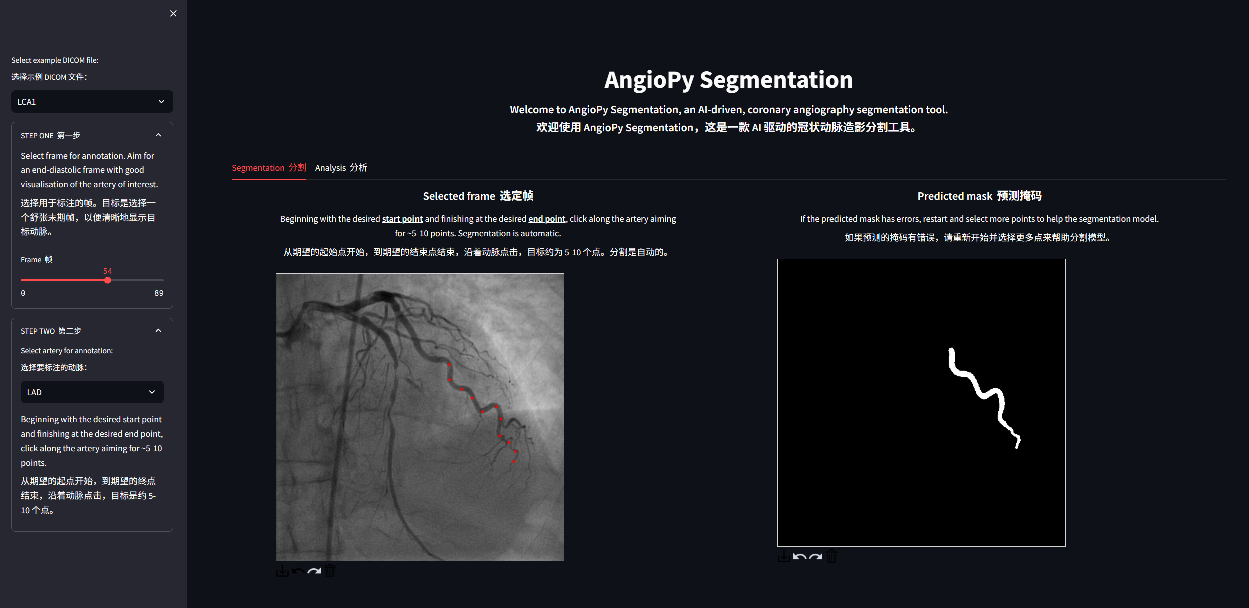 冠脉造影AI辅助诊断示例